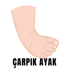çarpık ayak